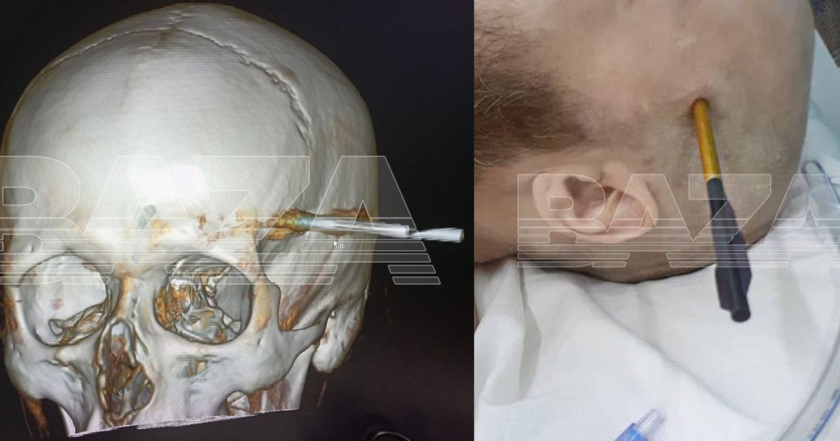 Доказано в Москве: от арбалетной стрелы в черепушке можно спасти