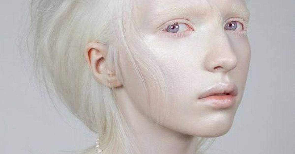 Альбиносы: экзотическая красота, но не без проблем со здоровьем