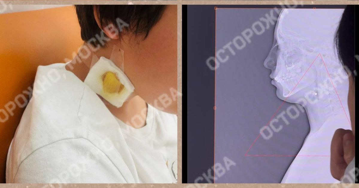 В Новой Москве подростки с пневматикой выстрелили ребёнку в горло