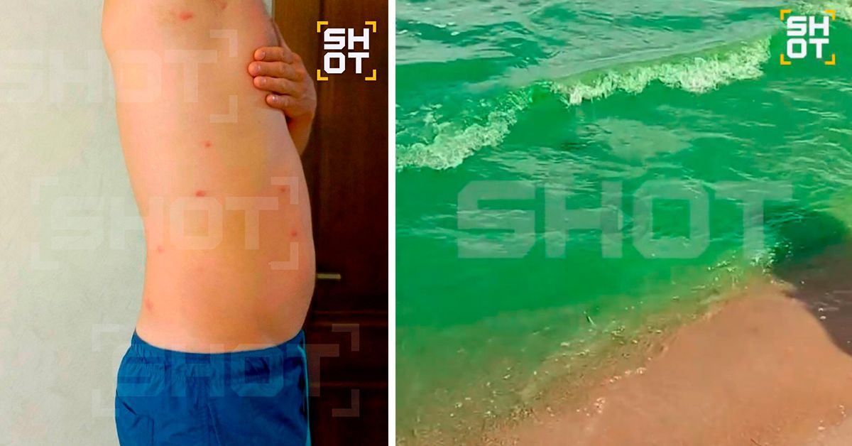 По российским пляжам стремительно проносится «зуд купальщика»