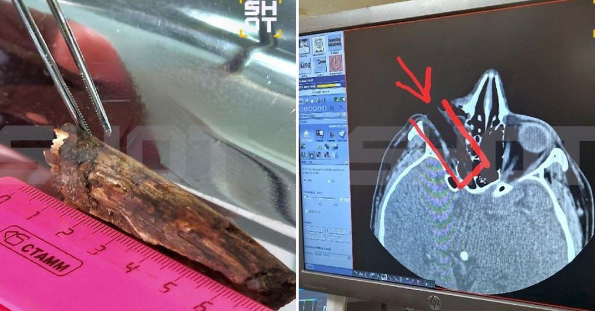 Древесный сучок чуть не затолкал глаз рыбака в его же мозг