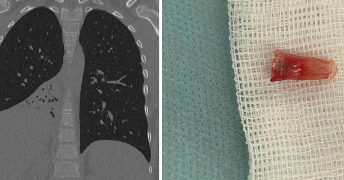 Москва: мальчонка полгода жил с пластиковым колпачком в бронхах