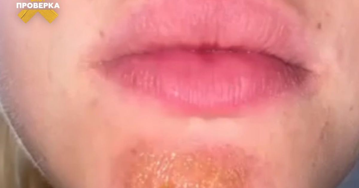 Девочки, тревога: импетиго! Результат поцелуев с бородачами