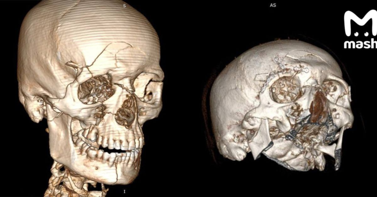Подмосковные хирурги сняли скальп с самокатчика