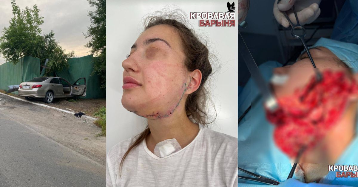 Хирурги спасли лицо девушке, чуть не потерявшей голову в ДТП