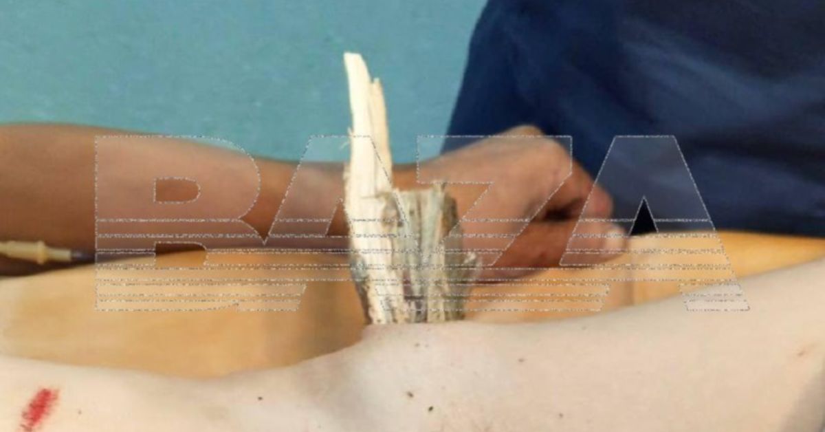 Редкостно повезло: спасен мужик, которому веткой пропороло живот Редкостно повезло: спасен мужик, которому веткой пропороло живот