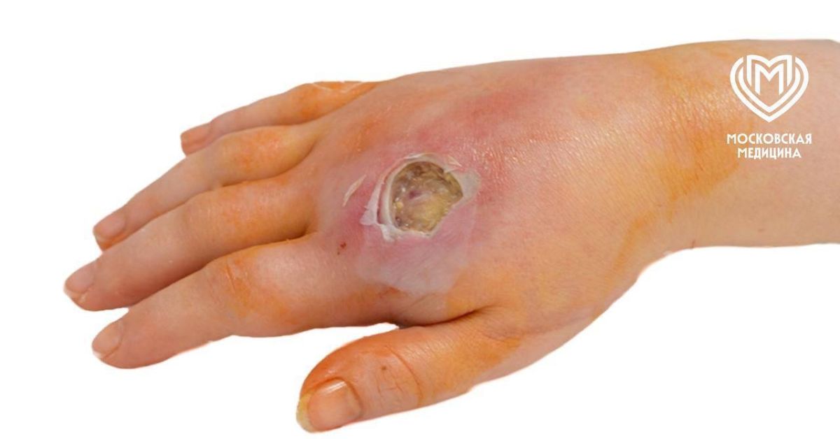 Девушка цапнута коброй в подмосковном лесу