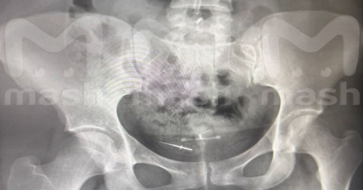 Ой, что это?! Стоматологический инструмент в кишечнике девушки из Башкирии