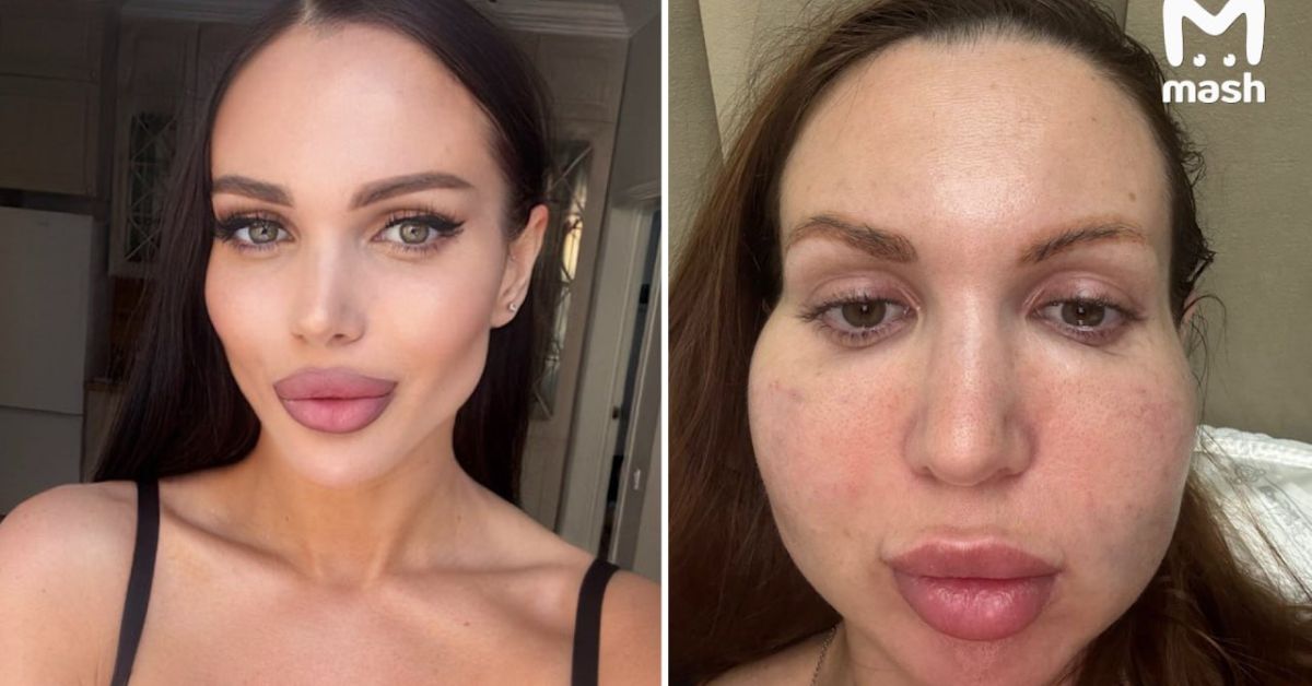 Ой, что это?! Последствия уколов красоты у самого дешевого косметолога Астаны