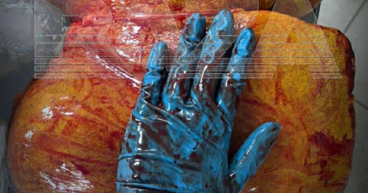 Ой, что это?! Гигантская печень-гигант (к сожалению, её обладательница скончалась)