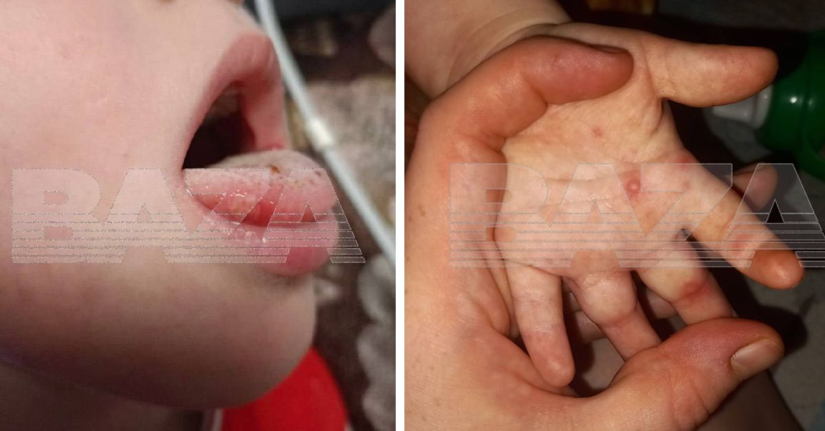 Родители в тревоге: в некоторых городах России разгулялся вирус Коксаки