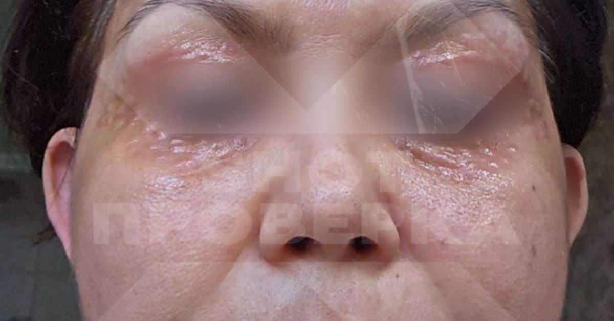 Ой, кто это?! Жертва паленого «Дермахила»