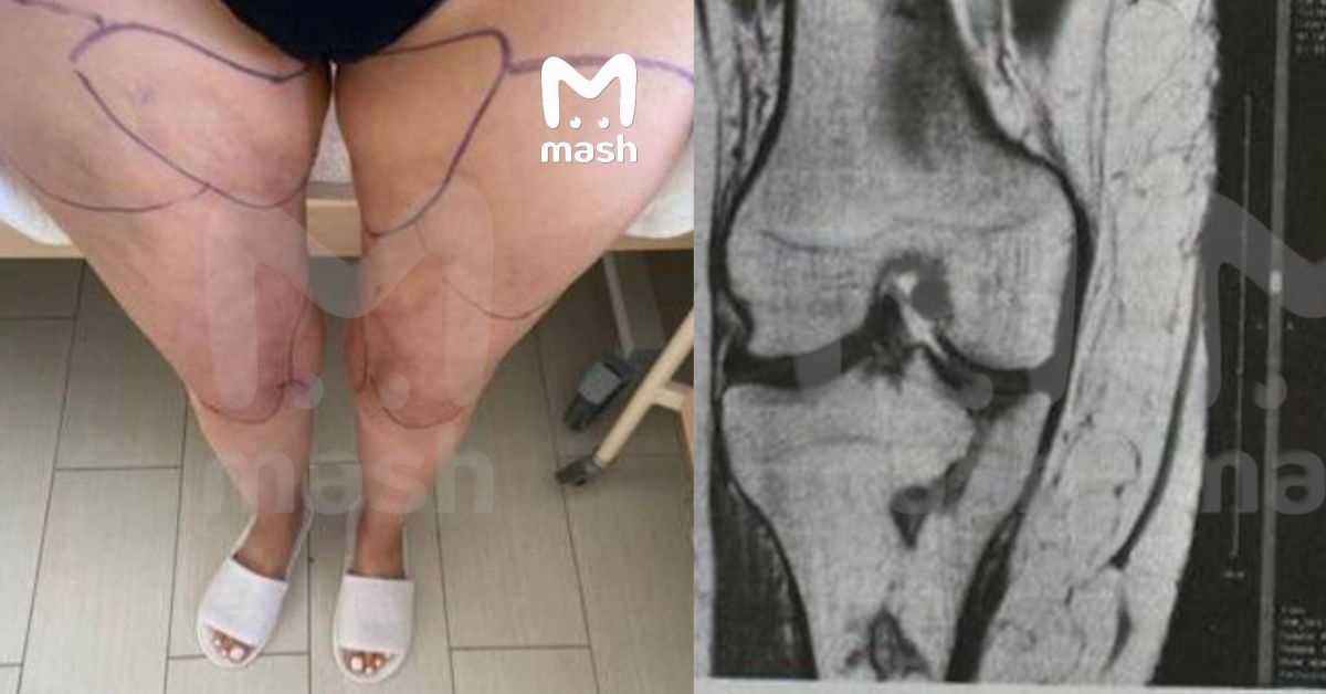 Невинная липоксация ягодиц поставила россиянку на грань ампутации ног