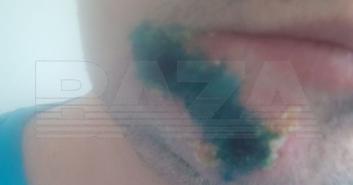 В Подмосковье обнаружилась пара носителей оспы обезъян